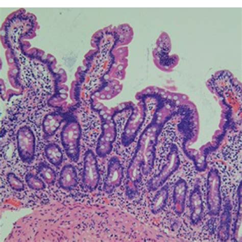 Biopsy Showed An Almost Complete Recovery Of The Villi On The Duodenal