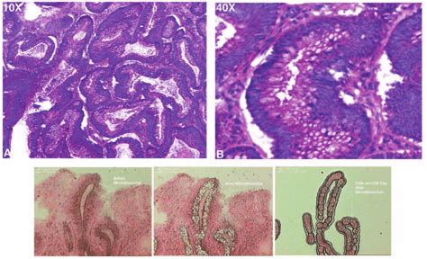 A Longitudinal H E Cryostat Section Of Colon Adenoma Exhibiting High