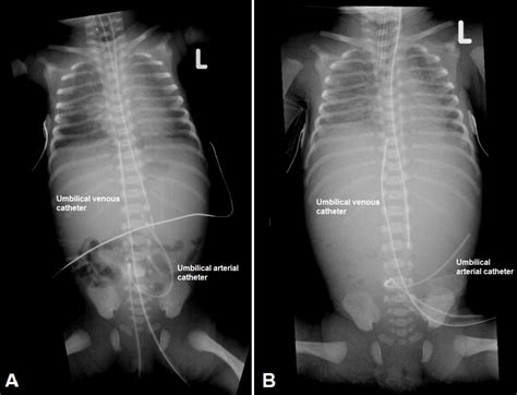 Abdominal Aortic Perforation By An Umbilical Arterial Catheter Adc