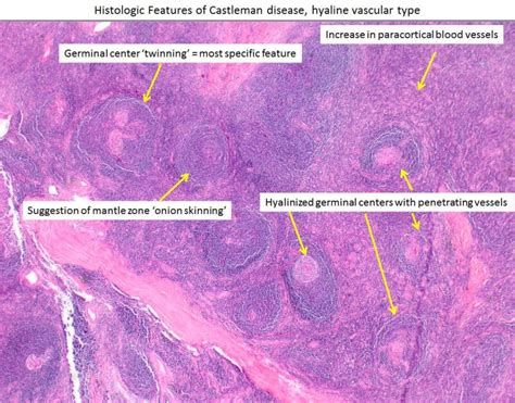 Figure Hyaline Vascular Castleman Disease Used By Permission By