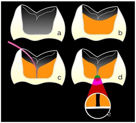 Dentistry Journal Free Full Text Resin Composites In Posterior