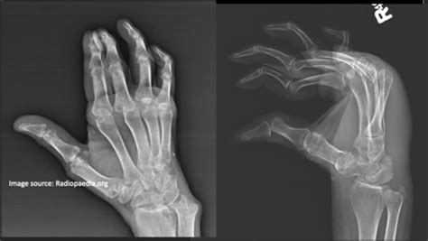 Introduction To Radiographic Evaluation Of Arthritis Flashcards Quizlet