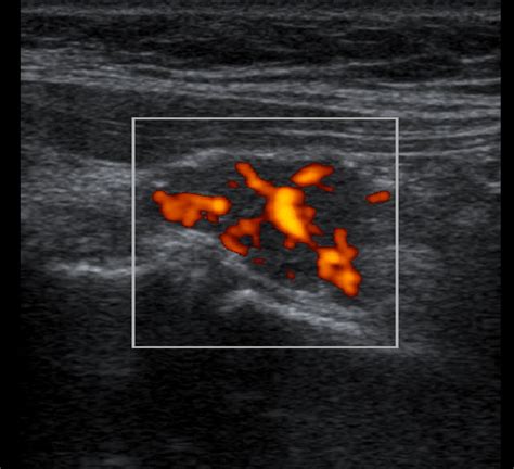 Doppler Sonogram Shows A Round Hypoechoic Intrathyroidal Adenoma Deep