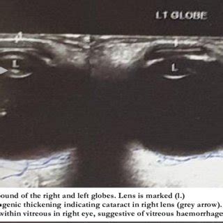 B-mode ultrasound showing an echogenic thickened and echogenic lens of ...