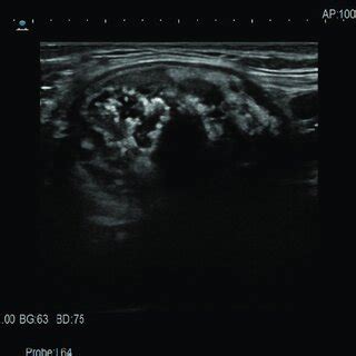 Healthy thyroid ultrasound image. | Download Scientific Diagram