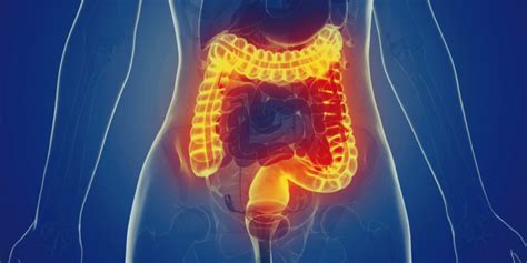 diverticulitis british colostomy