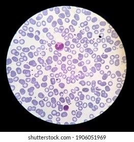 Rbc Morphology Blood Smear Normochromic Normocytic Stock Photo