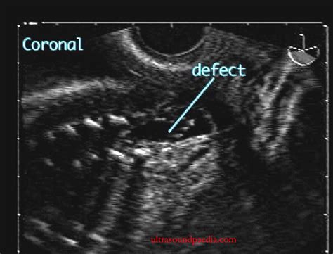 Myelomeningocele Ultrasoundpaedia