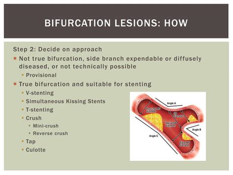 PPT Bifurcation Stenting A Primer PowerPoint Presentation Free