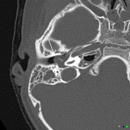 Otitis Media CT Scan