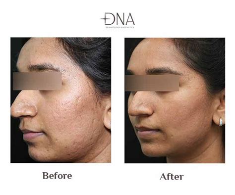 Acne Scar Treatment In Bangalore Acne Scar Treatment Cost In Bangalore