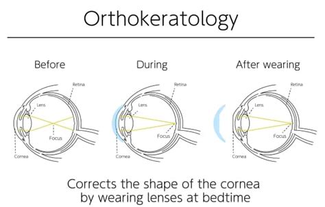 A Guide To Orthokeratology Answers To Faqs