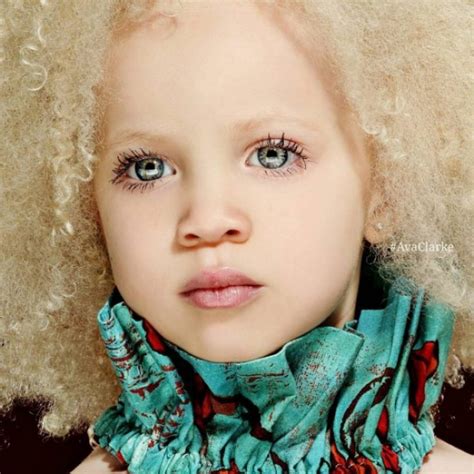 Pessoa Albina Negra - Menina negra com albinismo arrasa no mundo da moda por sua beleza - Geledés