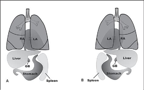 Heterotaxy Syndrome With Polysplenia Quotes Home