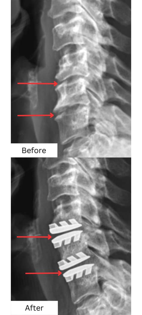 Cervical Disc Replacement - Excel Spine