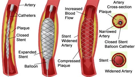 Stenting Procedure - Coastal Vascular Center