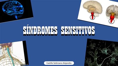 S Ndromes Sensitivos Alejandra Castillo Sol Rzano Udocz