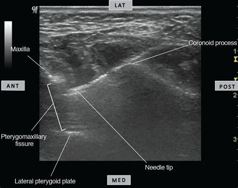 Ultrasound Guided Maxillary Nerve Block Via The Pterygopalatine Fossa