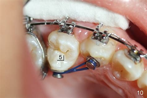 Orthodontic Attachment Lingual Buttons