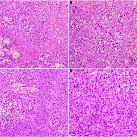 Hematoxylin Eosin Staining Of Secretory Carcinoma A 100Â B 200Â