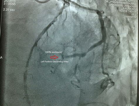 Dr.Nabil Paktin's Cardiology Blog مجله کاردیولوژی دکتور نبــیل پاکطـین : Acute Anterior and ...