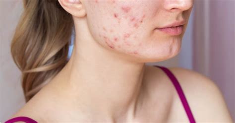 What Causes Cystic Acne In Women Expert Centre