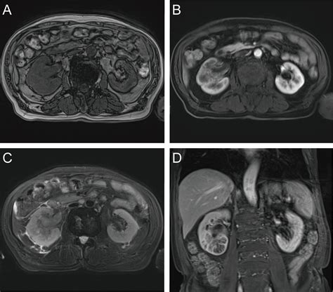 Frontiers Case Report Sarcomatoid Urothelial Carcinoma Of The Renal