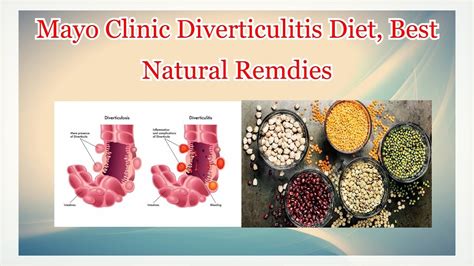 Mayo Clinic Diverticulitis Diet Best Natural Remdies Youtube