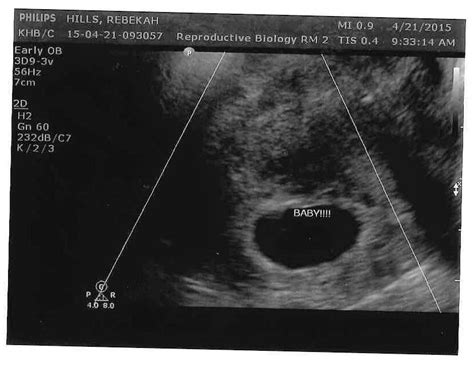 Ultrasound Update - 7 Weeks of Pregnancy