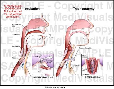 Intubation Vs Tracheostomy Medical Exhibit Medivisuals