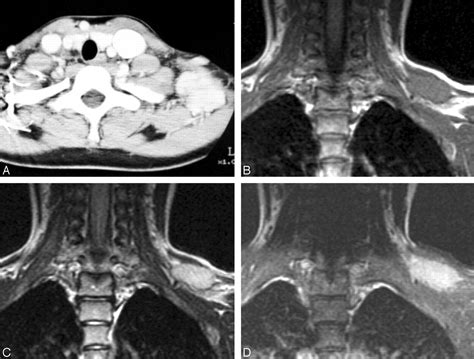 Nodular Fasciitis In The Head And Neck Ct And Mr Imaging Findings American Journal Of