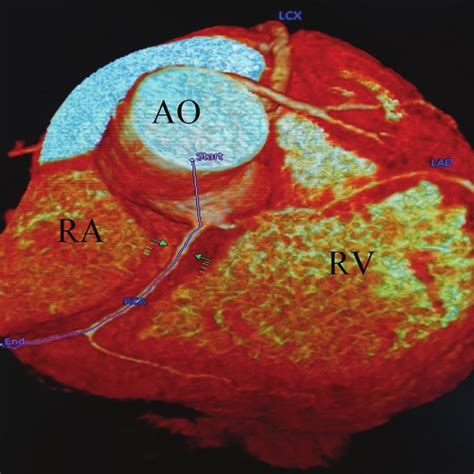 Coronary CT Angiogram Showing Lad Artery Arising from the Right ...