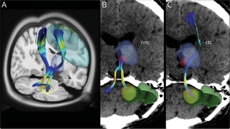 MRI tractography on a high-resolution DSI template from 60 healthy ...