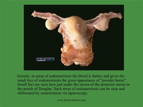 Endometriosis And Adenomyosis