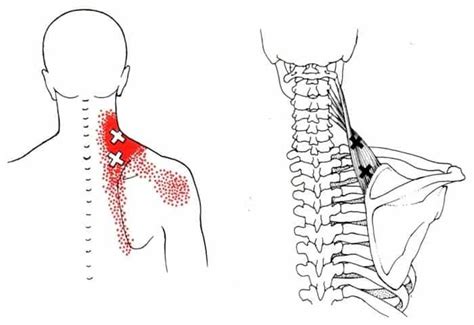 Do THIS Instead of a Levator Scapulae Stretch for Neck Pain - Precision ...