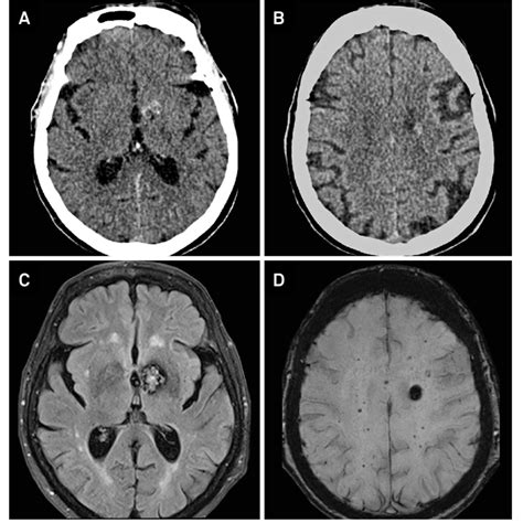 Basal Ganglia CT Scan