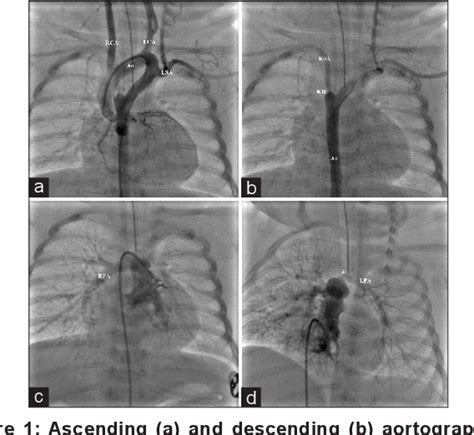 Figure 1 From Left Cervical And Circumflex Aortic Arch With Aberrant