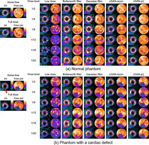 Deep Learning Based Denoising In Projection Domain And Reconstruction