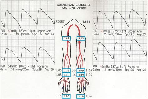 Upper Extremity Ultrasound Vein Mapping Worksheet