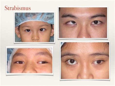 2015 Strabismus and Amblyopia