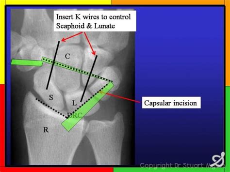 Scapholunate Ligament Repair And Dorsal Capsulodesis