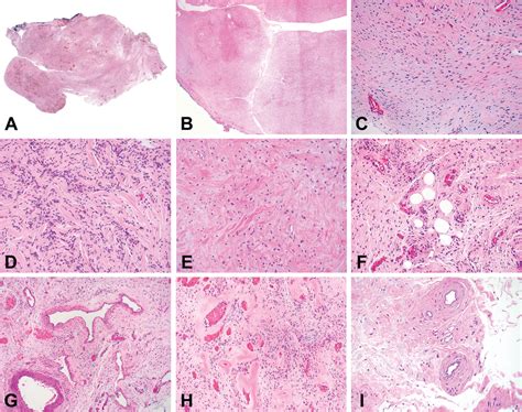 Prrx Rearranged Mesenchymal Tumors Are Usually Treated With