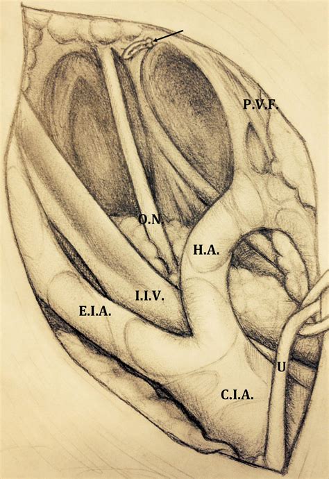 Scielo Brasil Robot Assisted Extended Pelvic Lymph Nodes Dissection