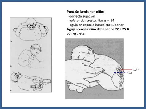 Enfermer En Urgencias Y Uci Técnica Xviii Punción Lumbar En Pediatría