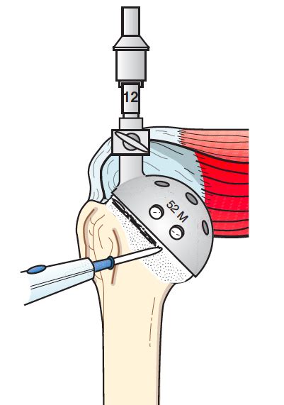 UW Shoulder And Elbow Academy Humeral Head Osteotomy In Shoulder