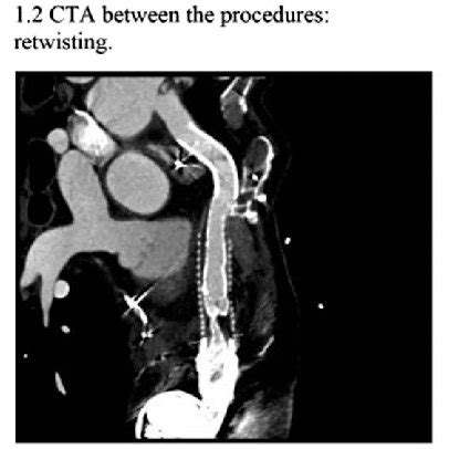 Computed tomography angiography (CTA) scans. | Download Scientific Diagram