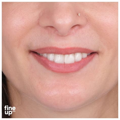 Emax Crowns at FineUp | Enhance Your Smile in Turkey