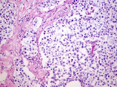 Pathology Outlines Seminoma