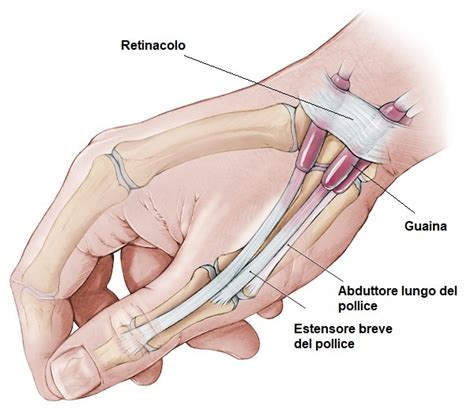 Sindrome Di De Quervain La Tendinopatia Del Pollice Sintomi E Trattamento