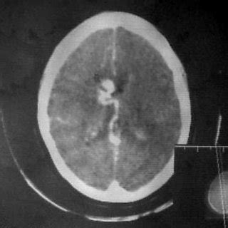 Contrast Enhanced Axial Brain Ct Showing Curvilinear Serpinginous